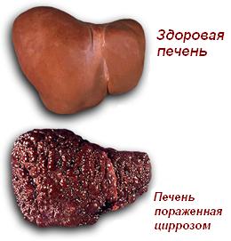 здоровая и больная печень