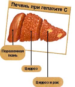 печень при гепатите С