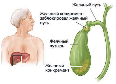 холецистит