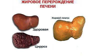 жировое перерождение печени