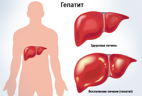 здоровая и больная печень