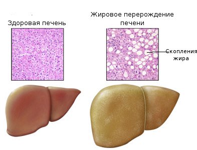 жировое перерождение печени