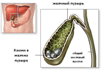камни в желчном пузыре
