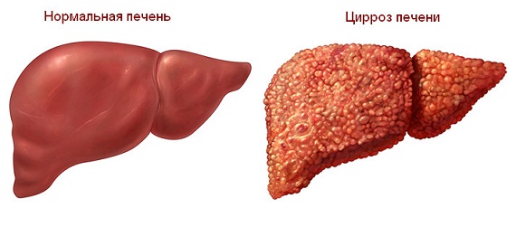 цирроз печени