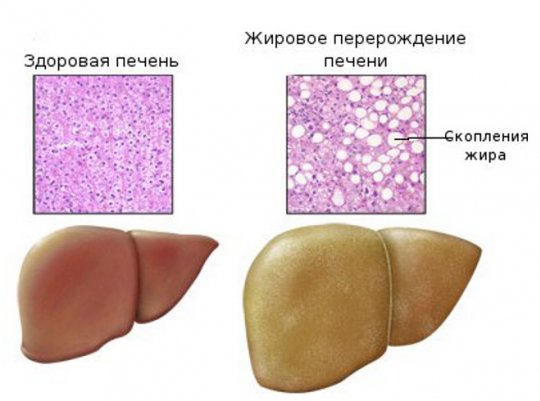 стеатоз печени